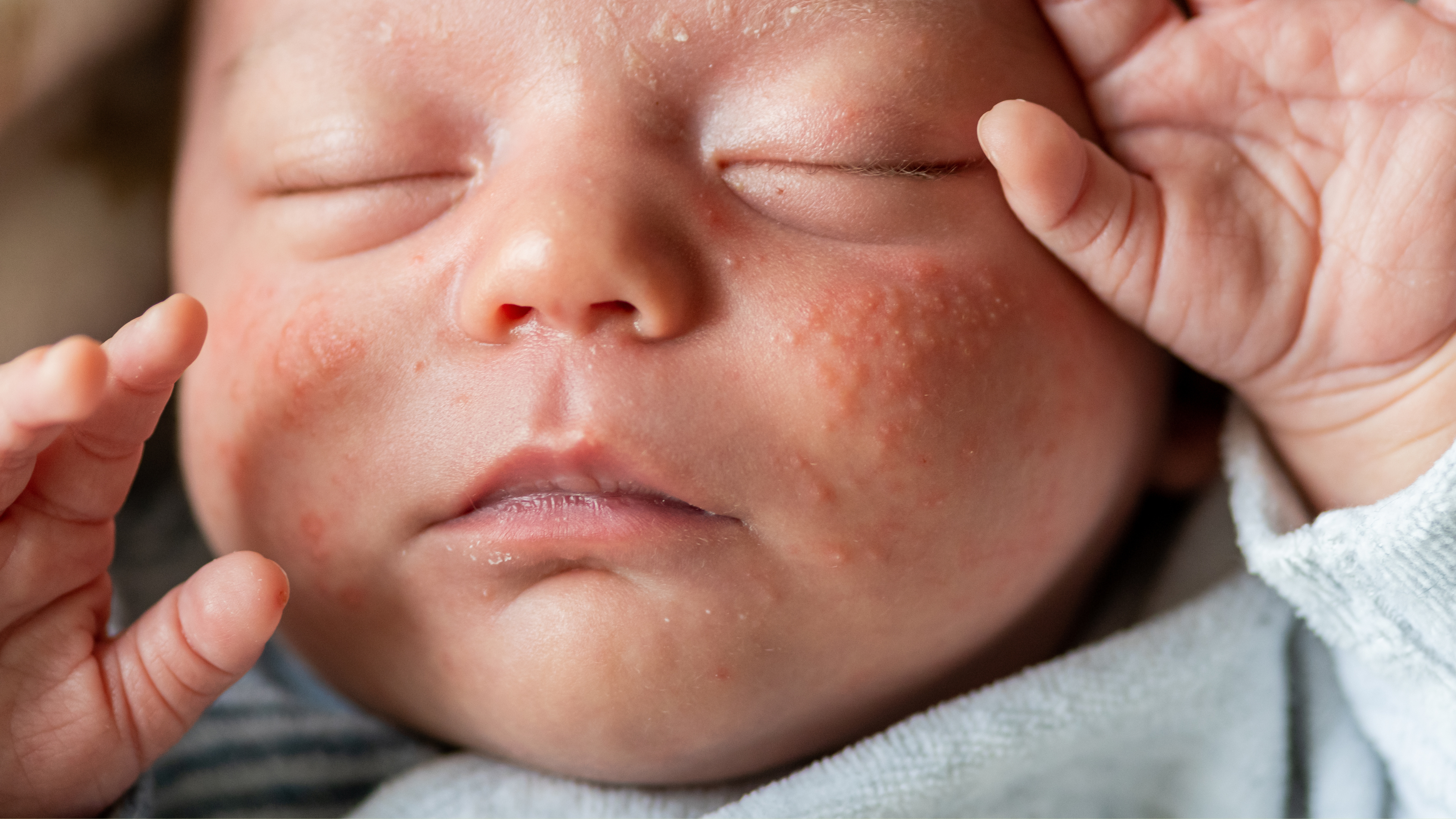 Babyacne: wat is het, hoe herken je het en wat kun je eraan doen?